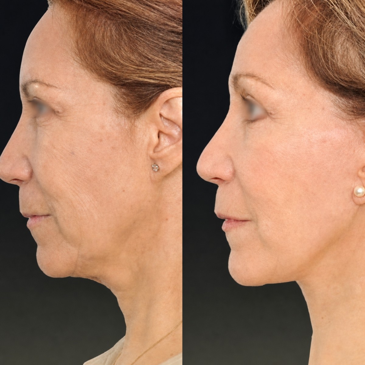 Facelift before and after results at Memorial Şişli Hospital, visible facial rejuvenation