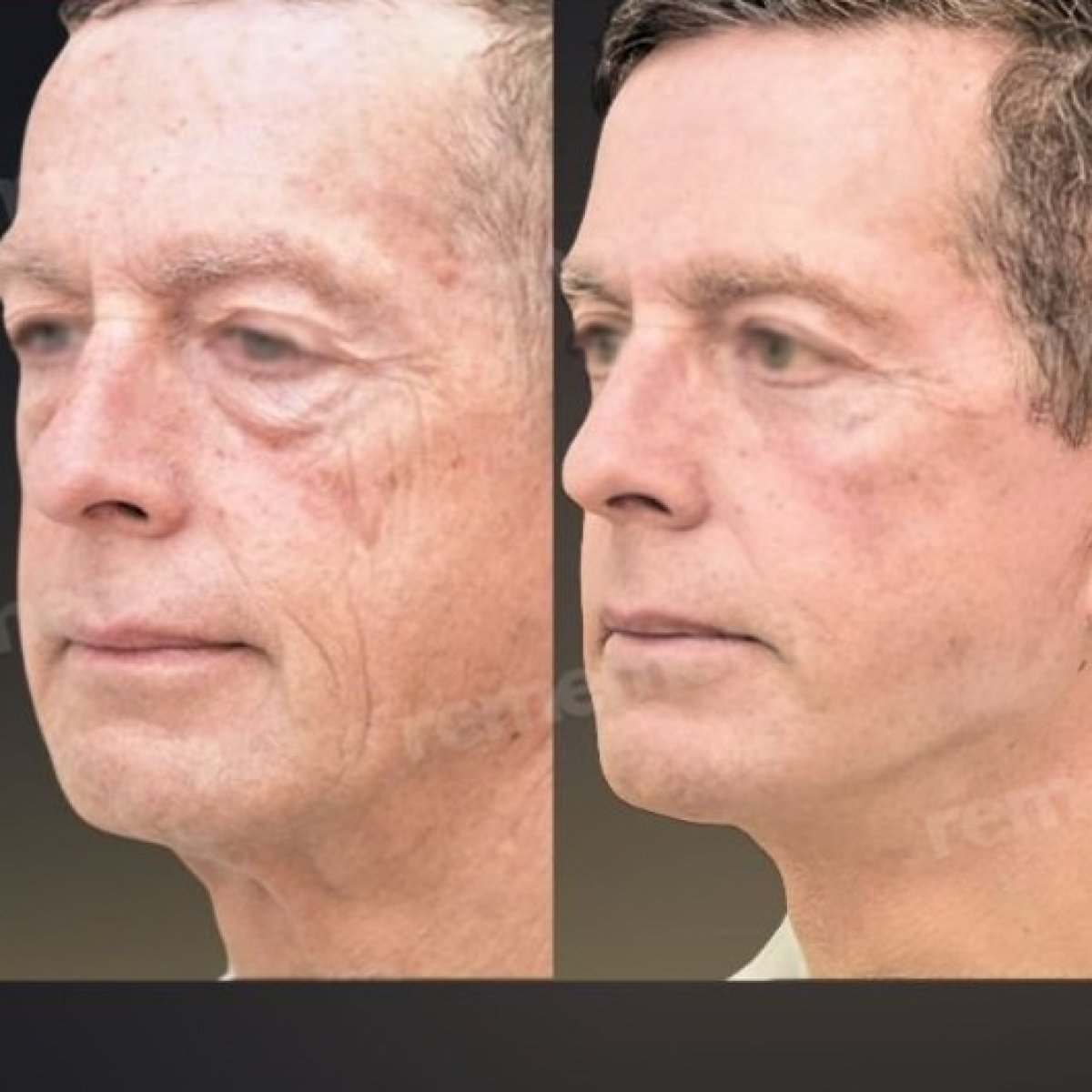 Facelift before and after results at Memorial Şişli Hospital, visible facial rejuvenation