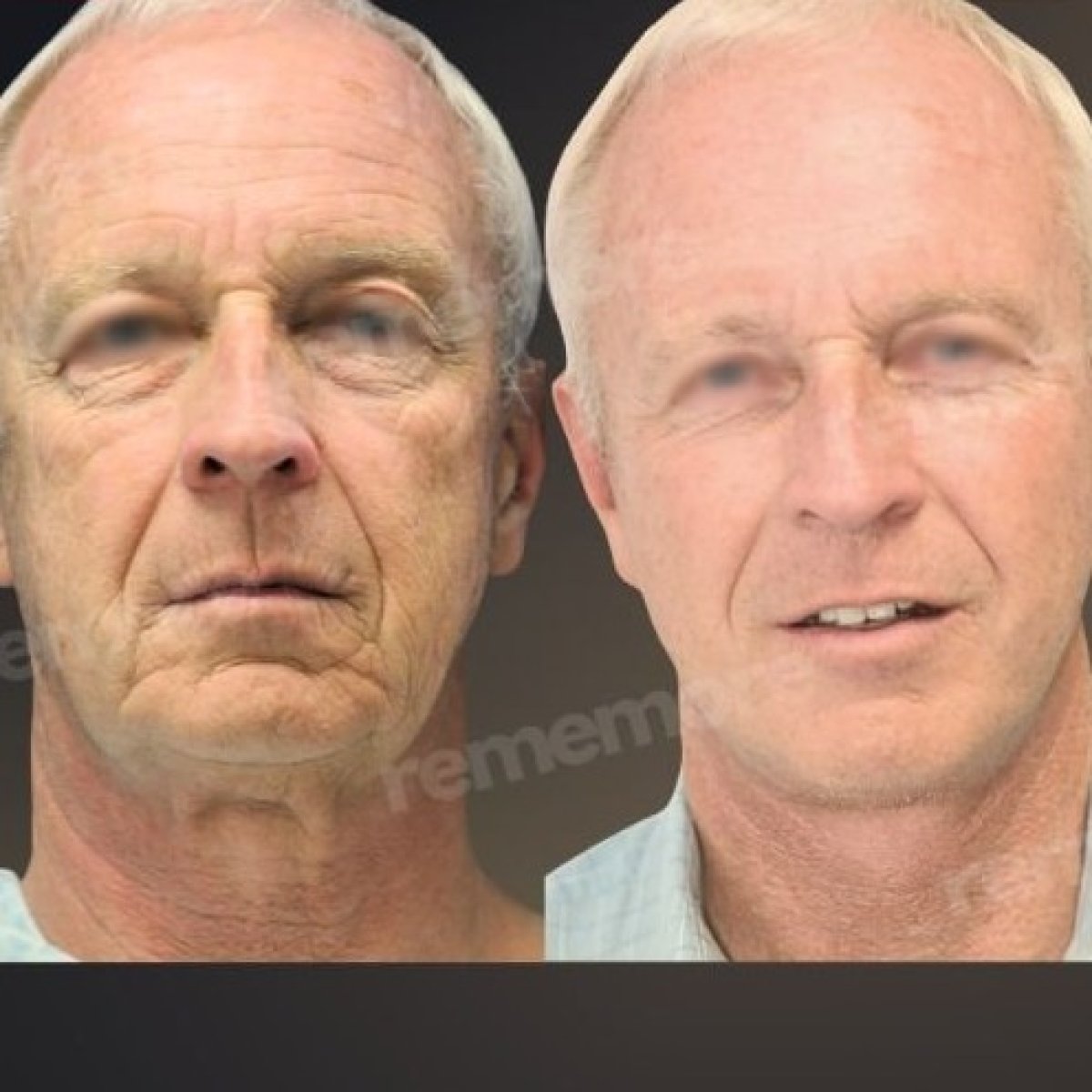Facelift before and after results at Memorial Şişli Hospital, visible facial rejuvenation