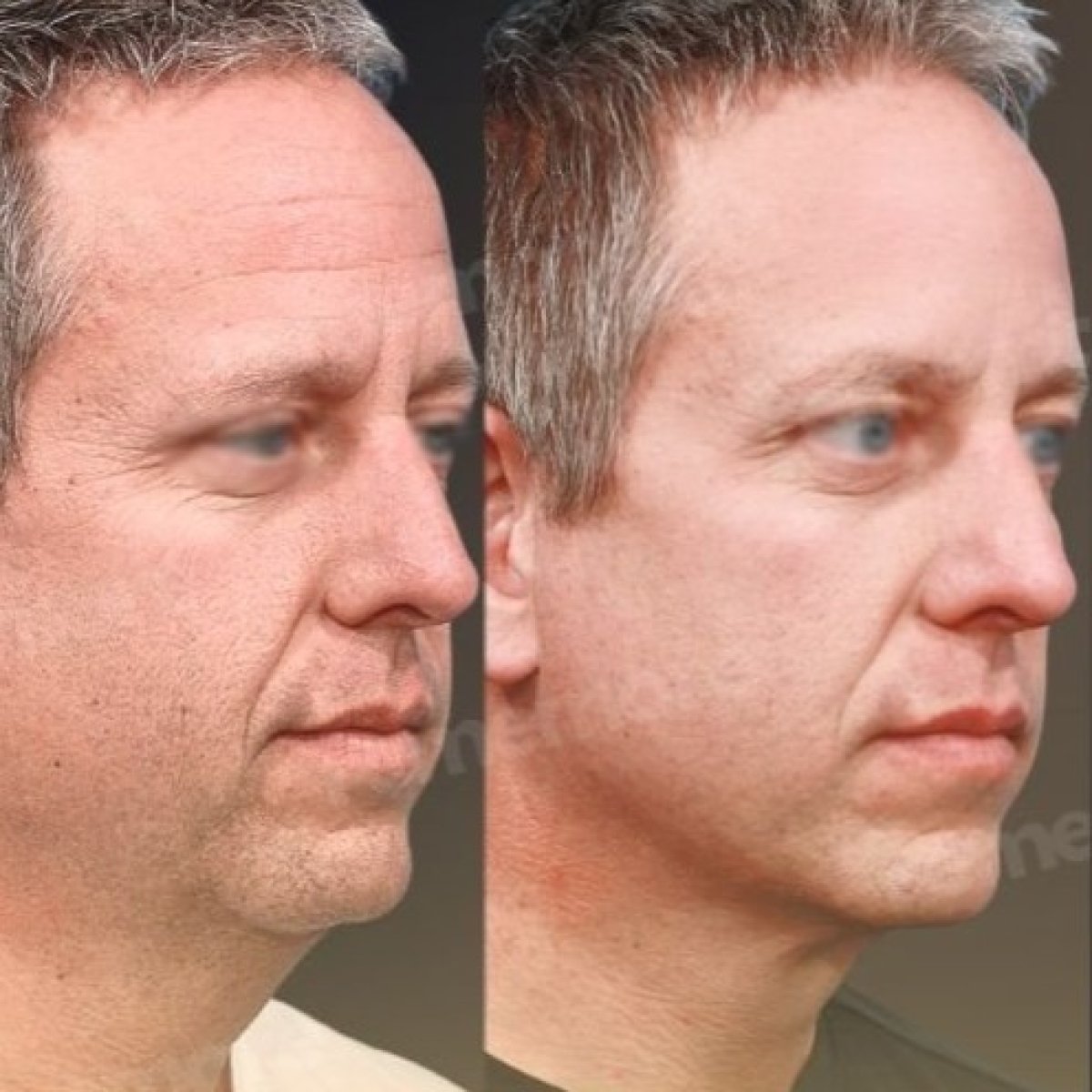 Facelift before and after results at Memorial Şişli Hospital, visible facial rejuvenation