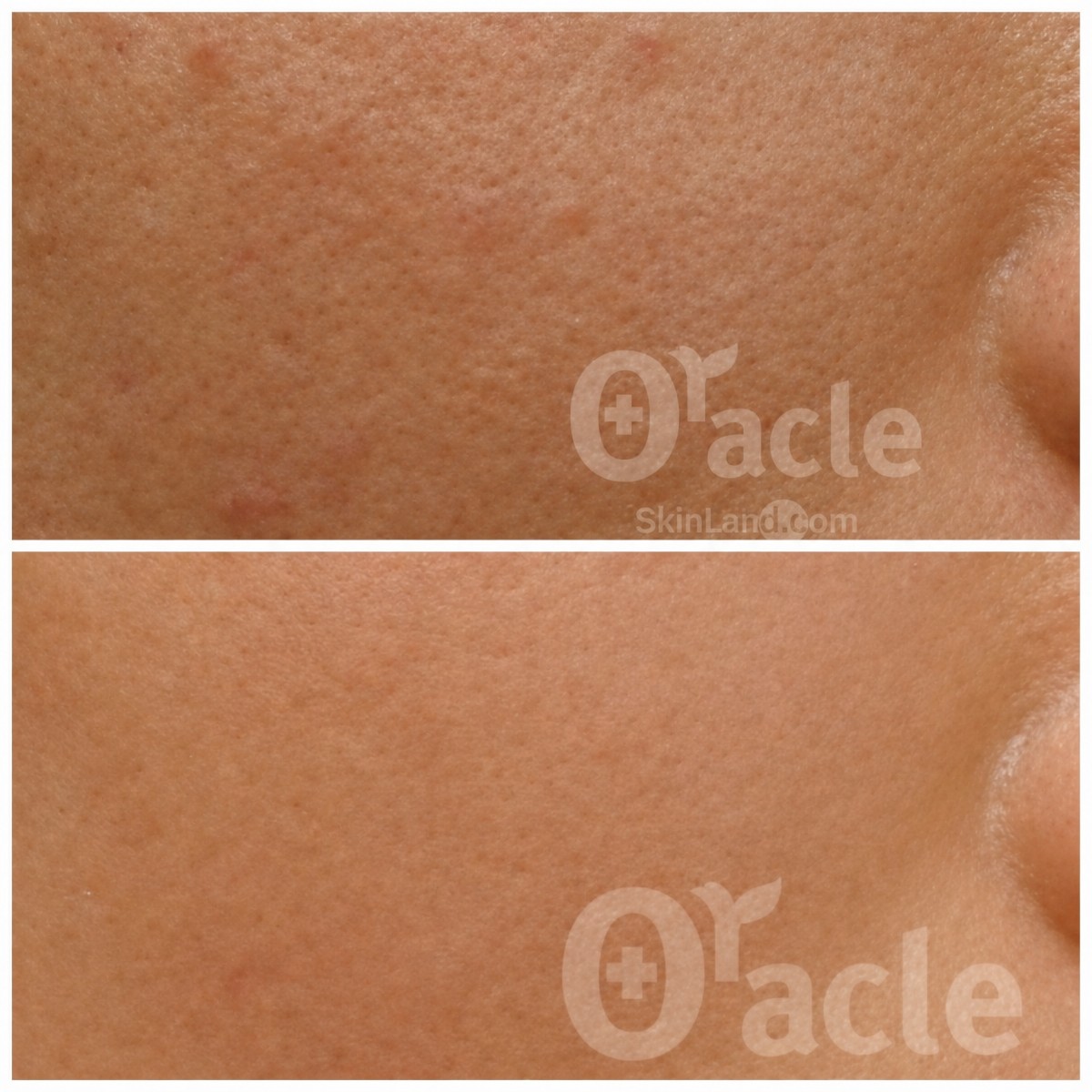 قبل وبعد تقشير البشرة بالليزر في Oracle Clinic Cheongdam، نتيجة بشرة أكثر نعومة