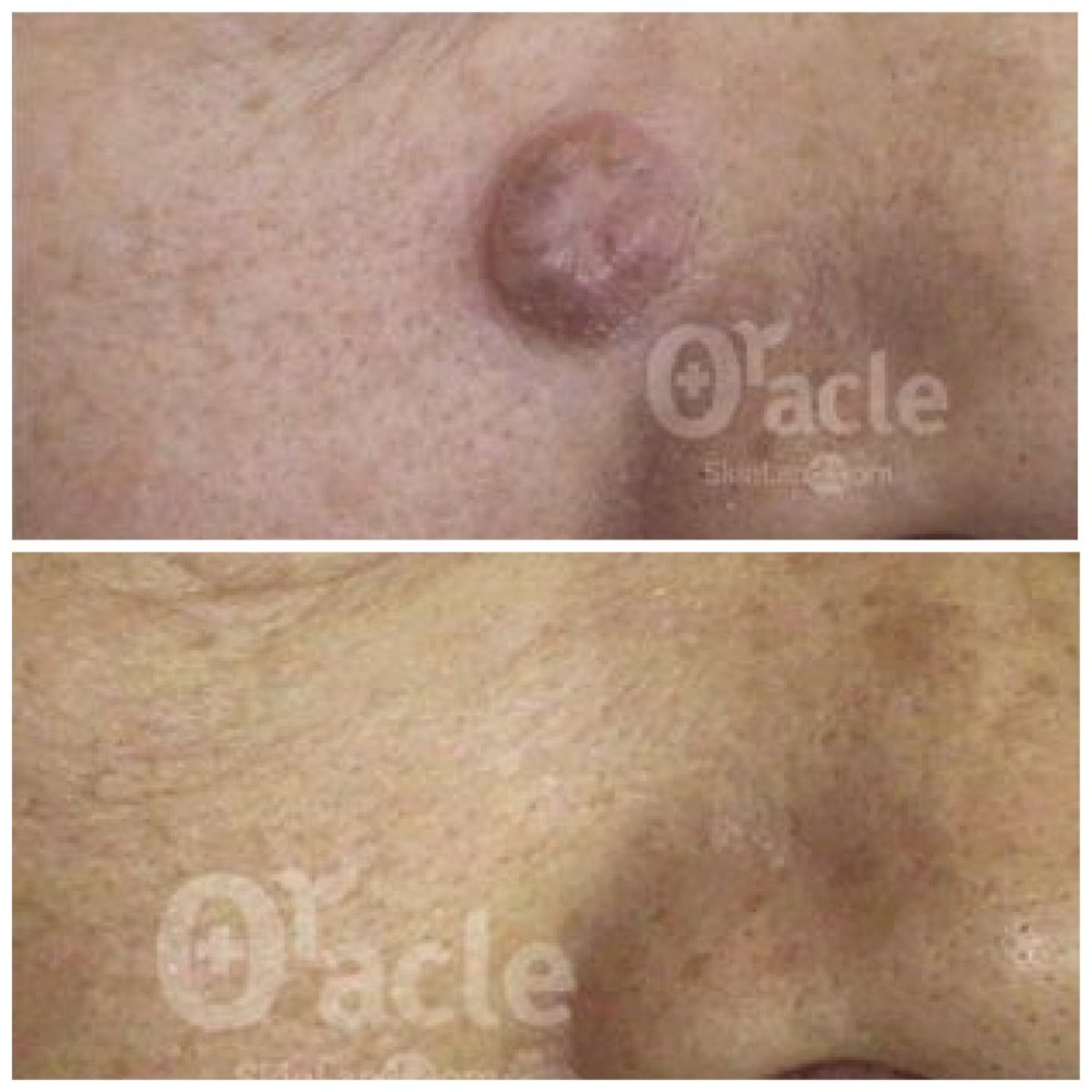 Результаты до и после удаления родинки в Oracle Clinic Cheongdam, улучшение кожи