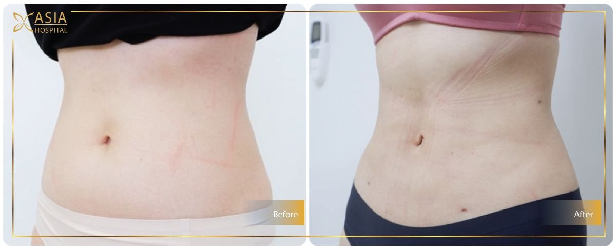 Before and after 360 liposuction results at Asia Cosmetic Hospital, visible waist contouring