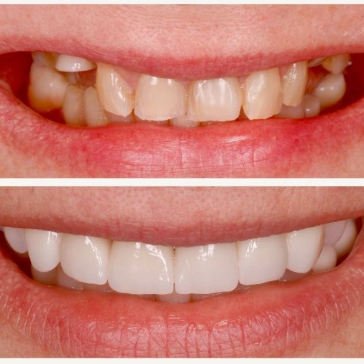 Результати до і після імплантації зубів у BMC Dental Klinik, покращена посмішка