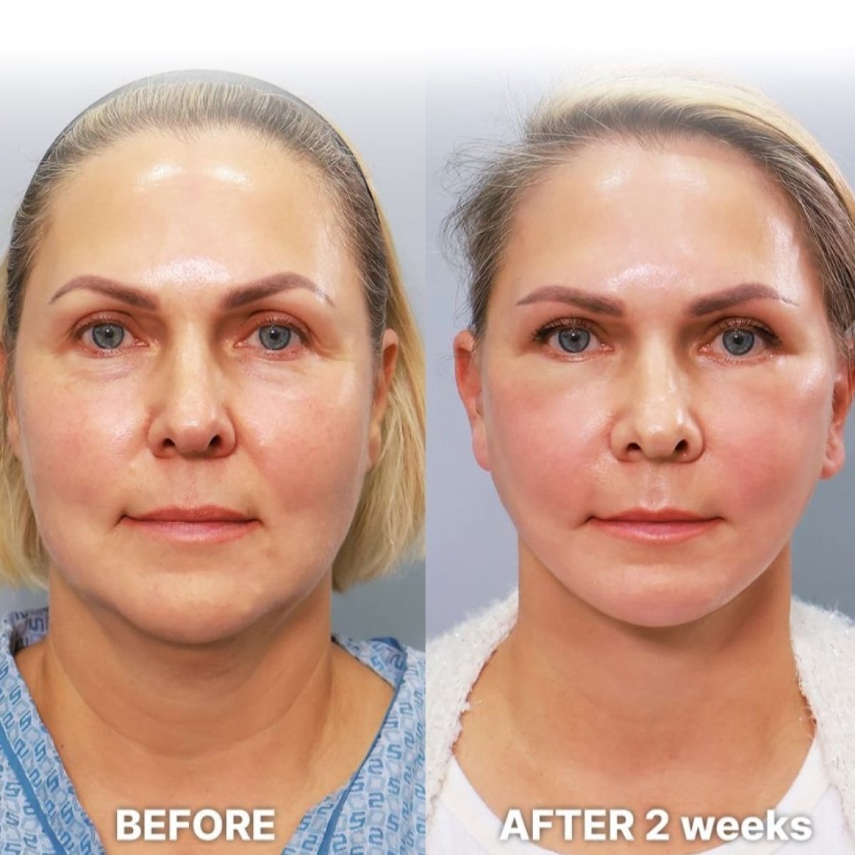 Facelift before and after results at Returning Plastic Surgery, visible facial rejuvenation in 2 weeks