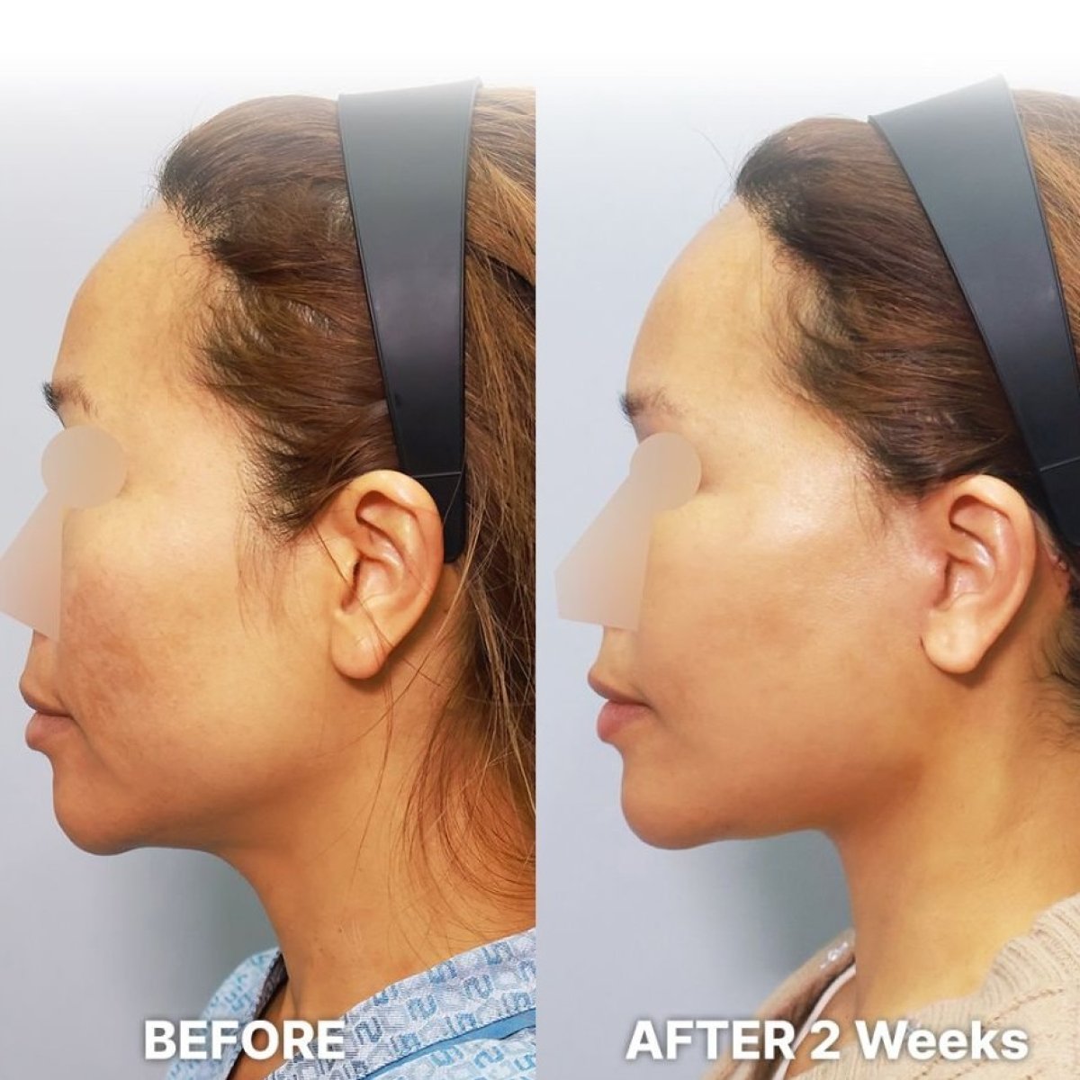 Facelift Vorher-Nachher-Ergebnisse bei Returning Plastic Surgery – verbesserte Gesichtskontur