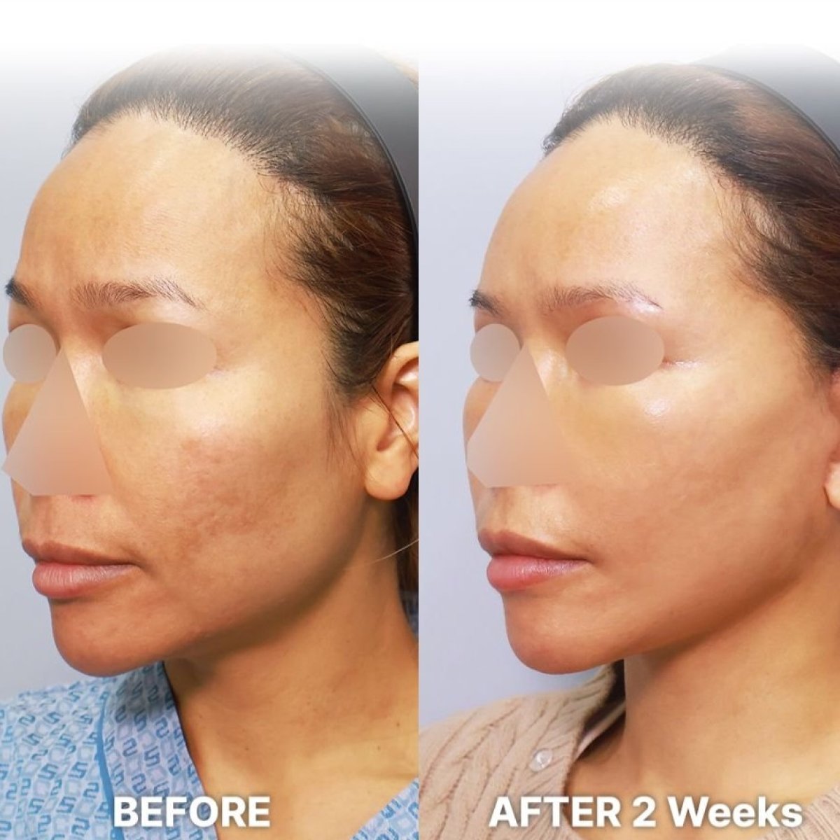 Facelift before and after results at Returning Plastic Surgery, visible facial rejuvenation