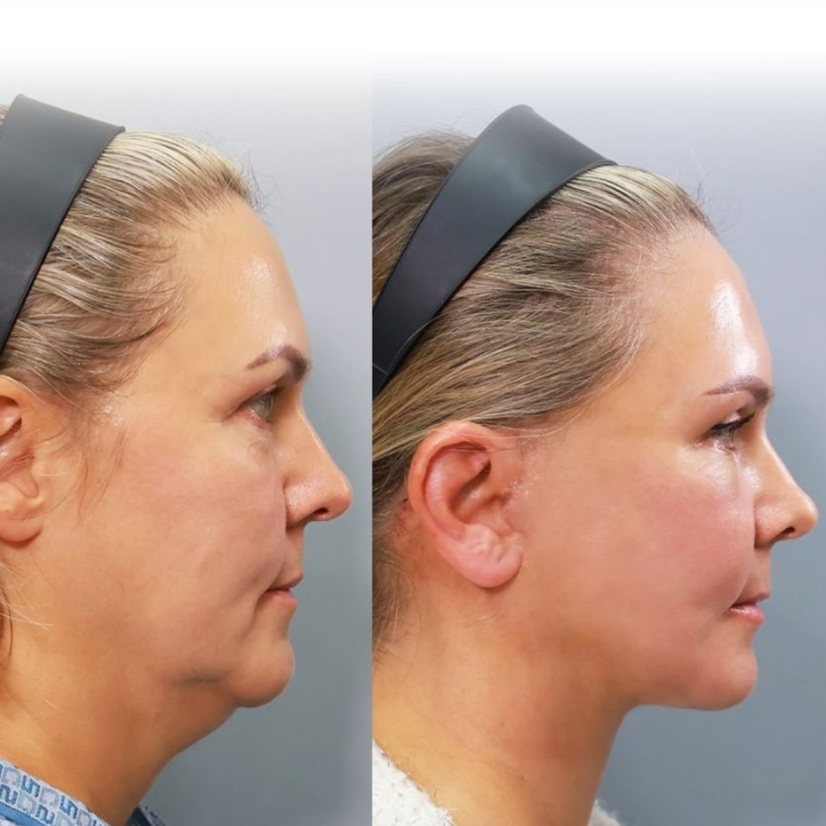 Facelift before and after results at Returning Plastic Surgery – visible facial contour improvement