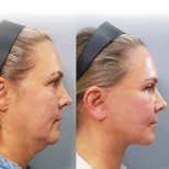 Dr. Yong Woo Kim тарапынан Бет көтеру бұрын және кейін фотосуреттері