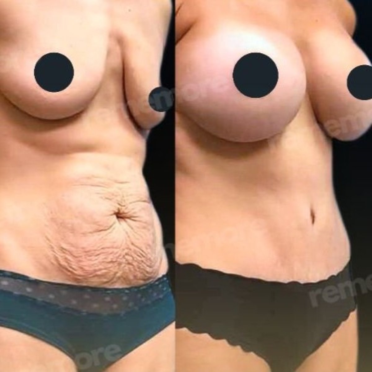 Résultats avant/après augmentation mammaire et abdominoplastie à Memorial Bahçelievler Hospital