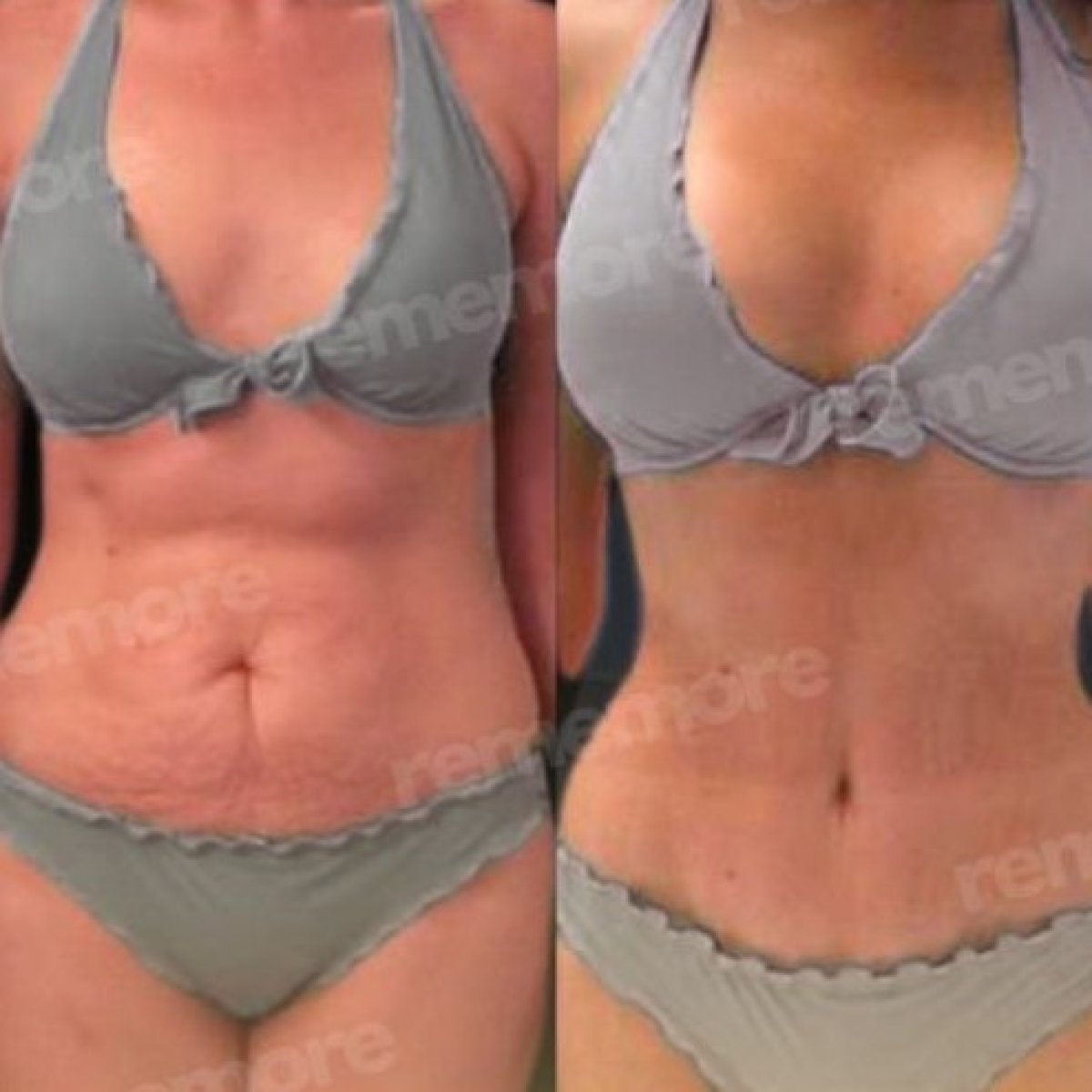 Resultados de abdominoplastia antes y después en Memorial Bahçelievler Hospital, abdomen plano