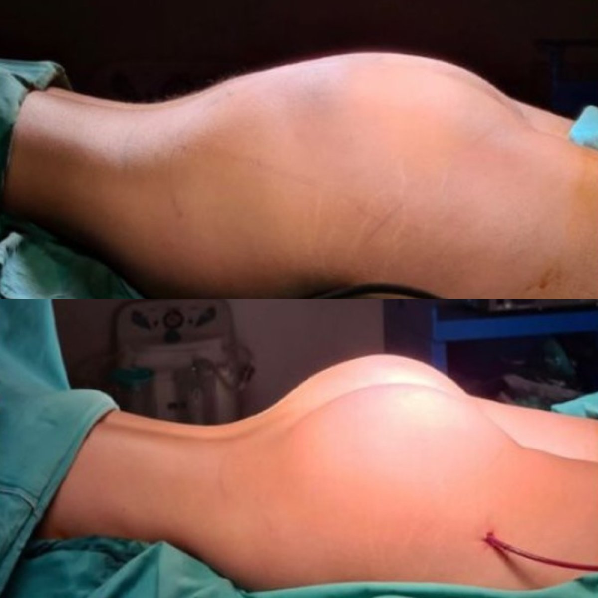 قبل وبعد زرع المؤخرة في مستشفى ميموريال غوزتيبي، نتيجة تحسين الشكل