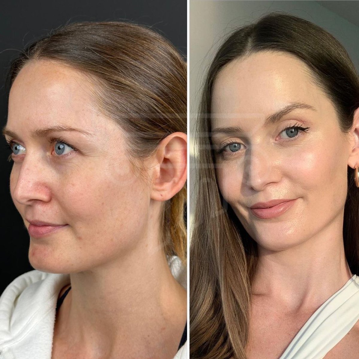 Resultados de blefaroplastia superior antes y después en Dr. Safa Manav Clinic, rejuvenecimiento ocular