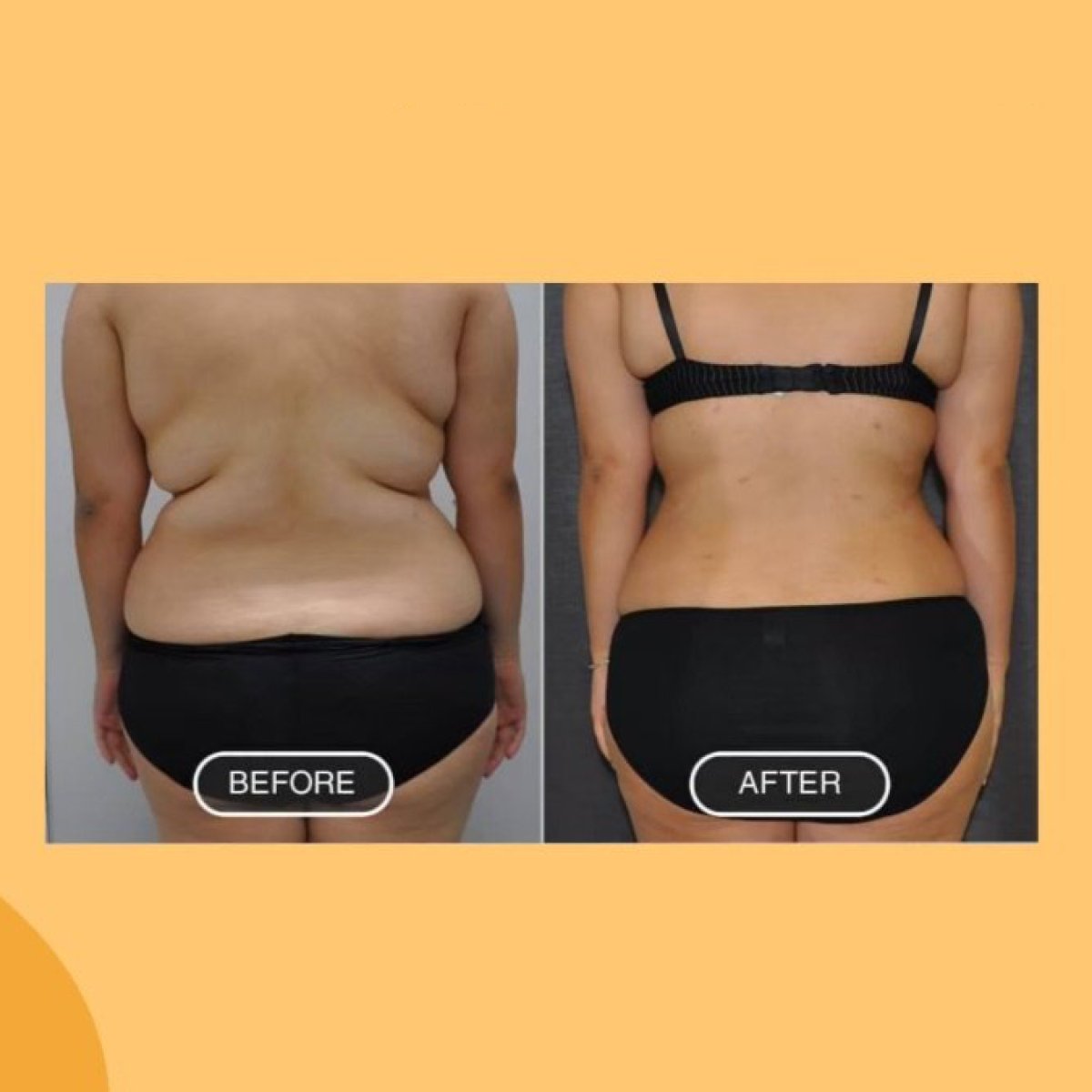 Before and after liposuction results at ID Clinic Bangkok, visible body contour improvement