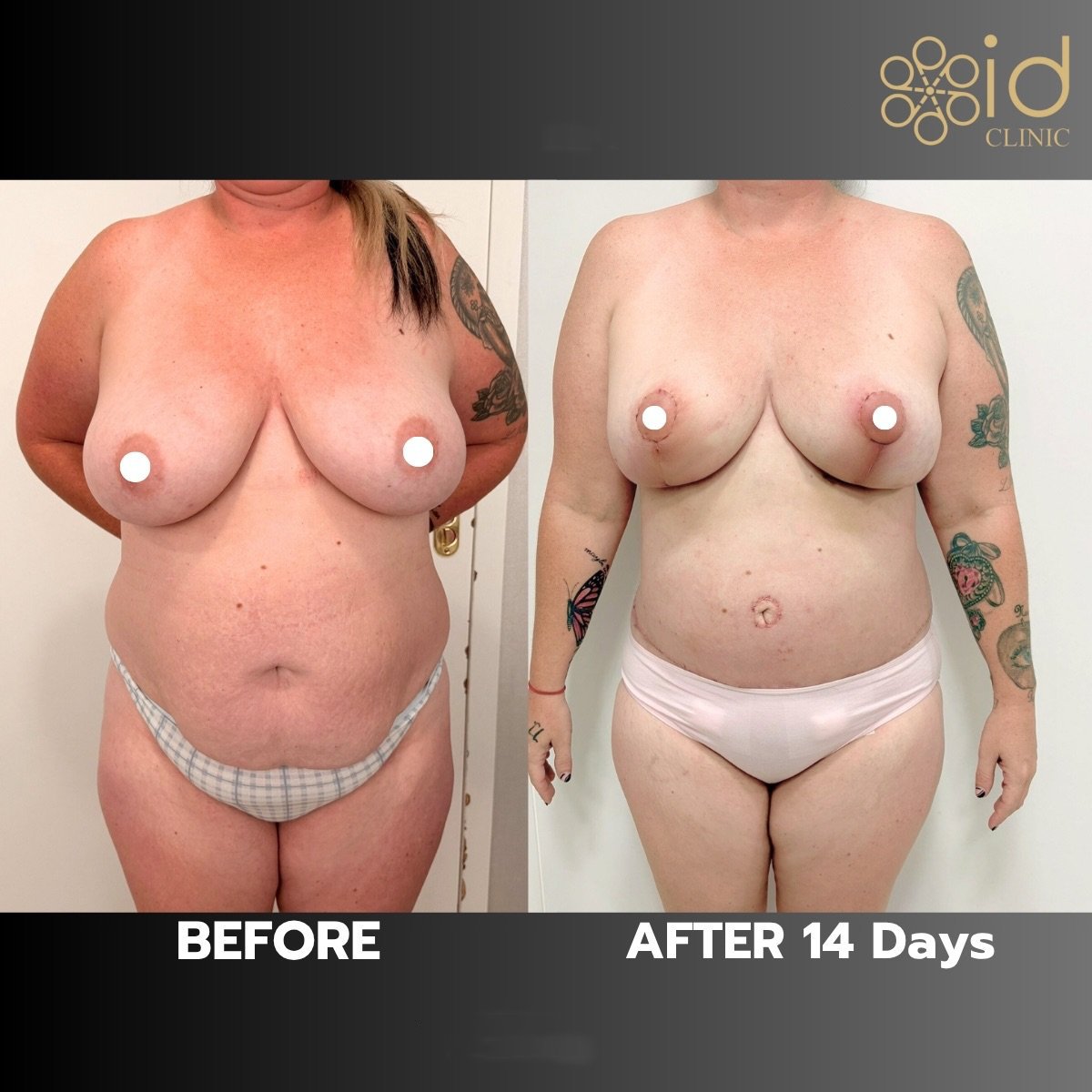 Before and after tummy tuck results at ID Clinic Bangkok, visible abdominal contour improvement