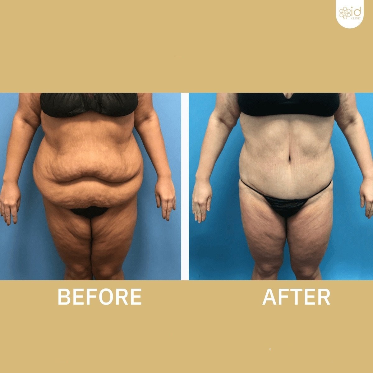 Before and after tummy tuck results at ID Clinic Bangkok, visible abdominal contour improvement