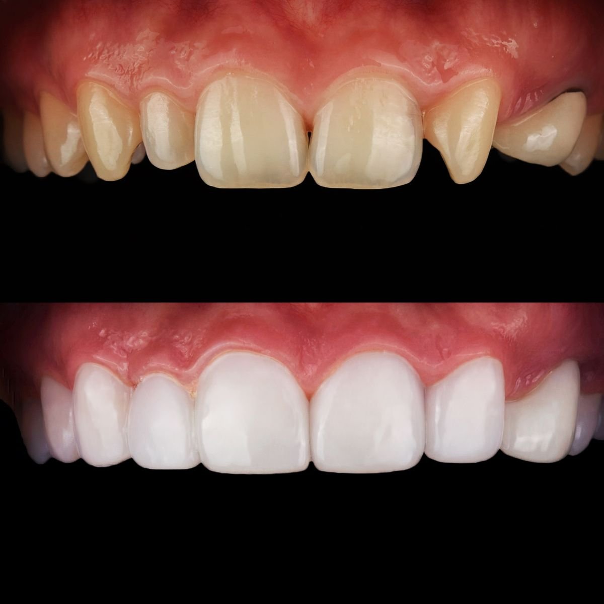 Результат до и после установки виниров в 365SeoulOneTop365 Dental Clinic, преображение улыбки