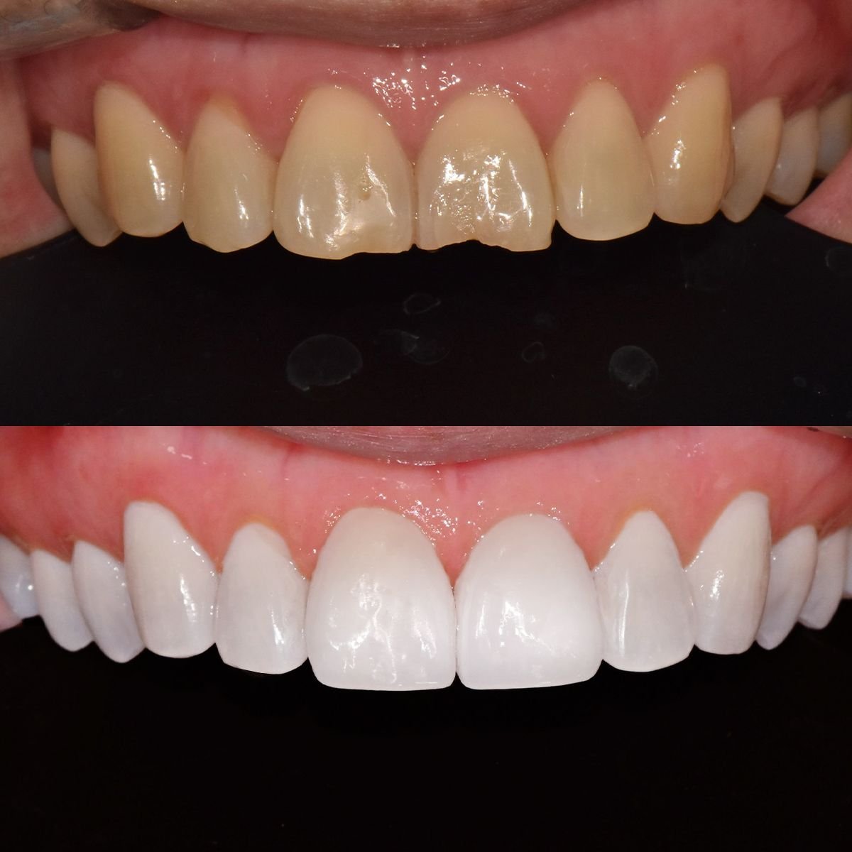 Resultados de carillas antes y después en 365SeoulOneTop365 Dental Clinic – transformación de sonrisa
