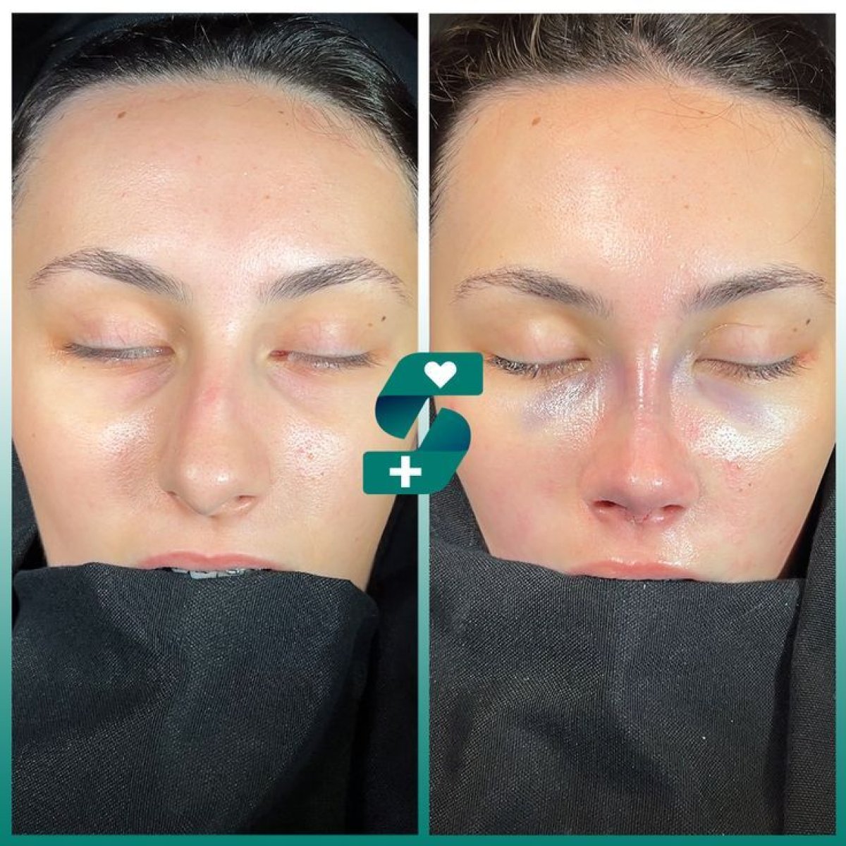 Before and after rhinoplasty results at Soraca Med, visible nose reshaping and refinement