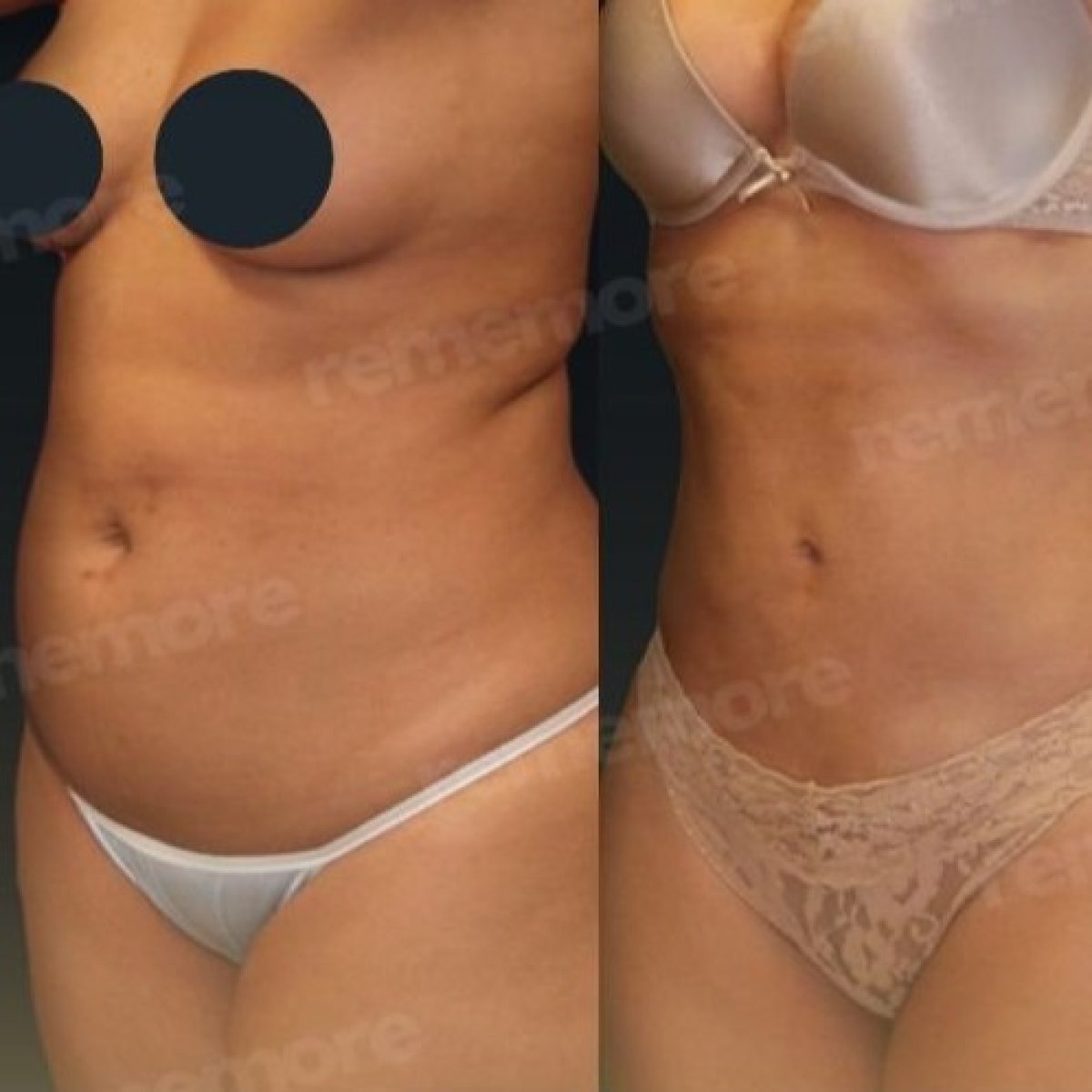 Vorher-nachher-Ergebnis 360°-Liposuktion bei Memorial Bahçelievler Hospital, Körperkontur
