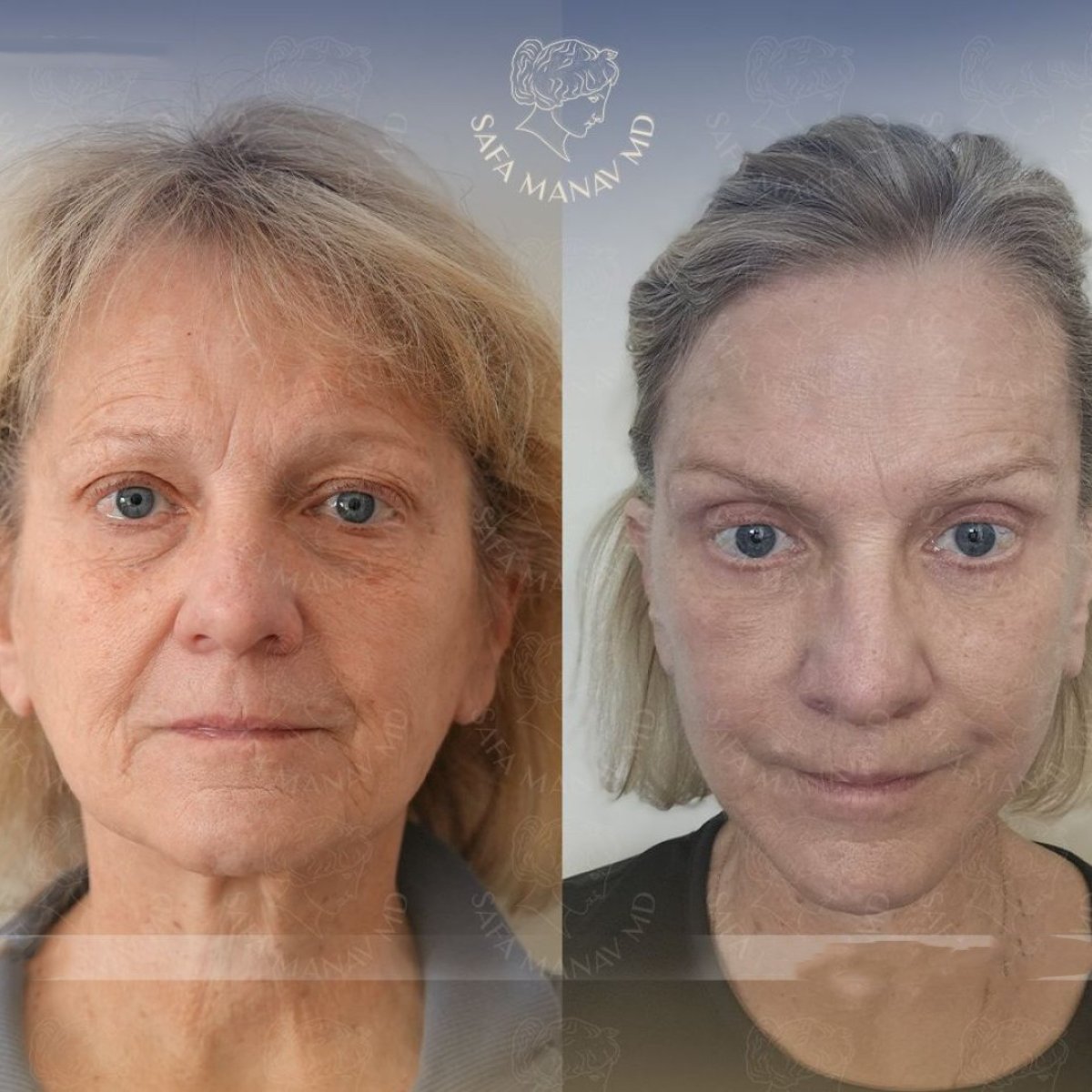 Vorher-nachher-Ergebnis der Gesichtsfetttransplantation in der Dr. Safa Manav Klinik