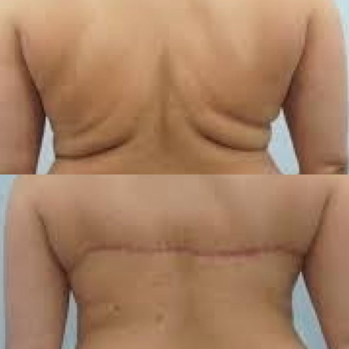 Before and after back lift results at ID Clinic Bangkok, improved back contour and skin tightening