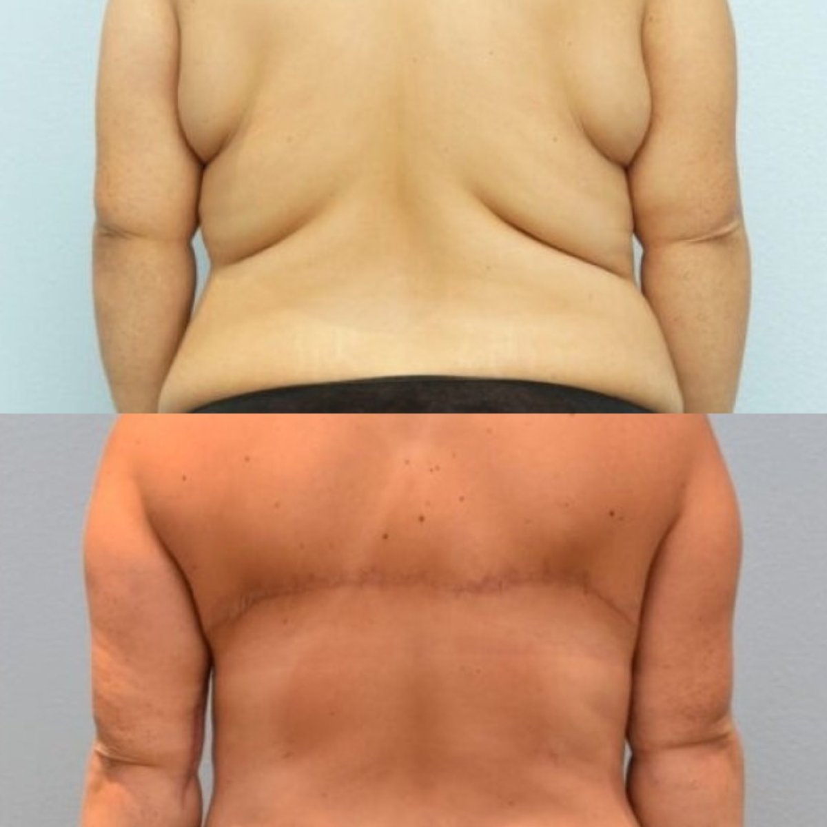 Résultats avant et après lifting du dos à ID Clinic Bangkok, contour du dos amélioré