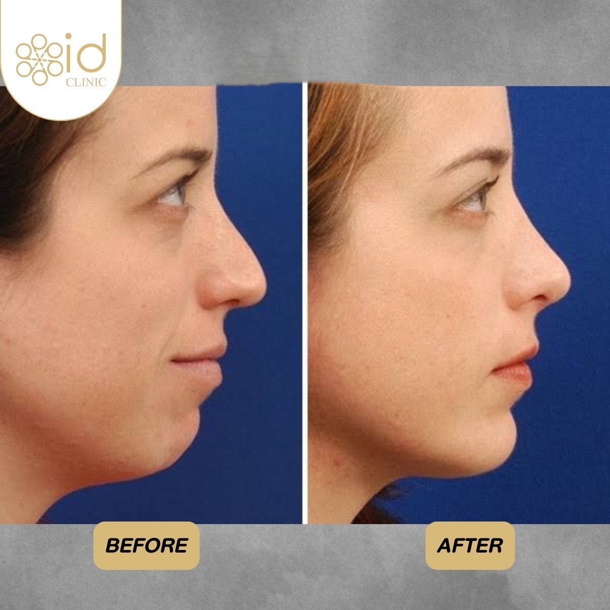 Before and after rhinoplasty results at ID Clinic Bangkok, nose reshaping with natural look