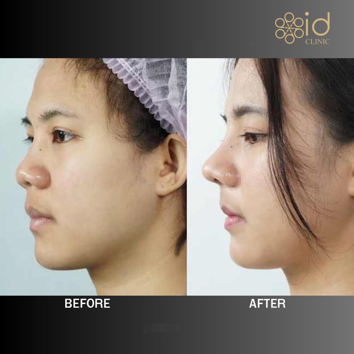 Before and after rhinoplasty result at ID Clinic Bangkok, nose reshaping with natural look