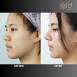 Fotos vor und nach Rhinoplastik (Nasenkorrektur) durch Dr. Dr Phatcharasak Kraisornphongsakul Md