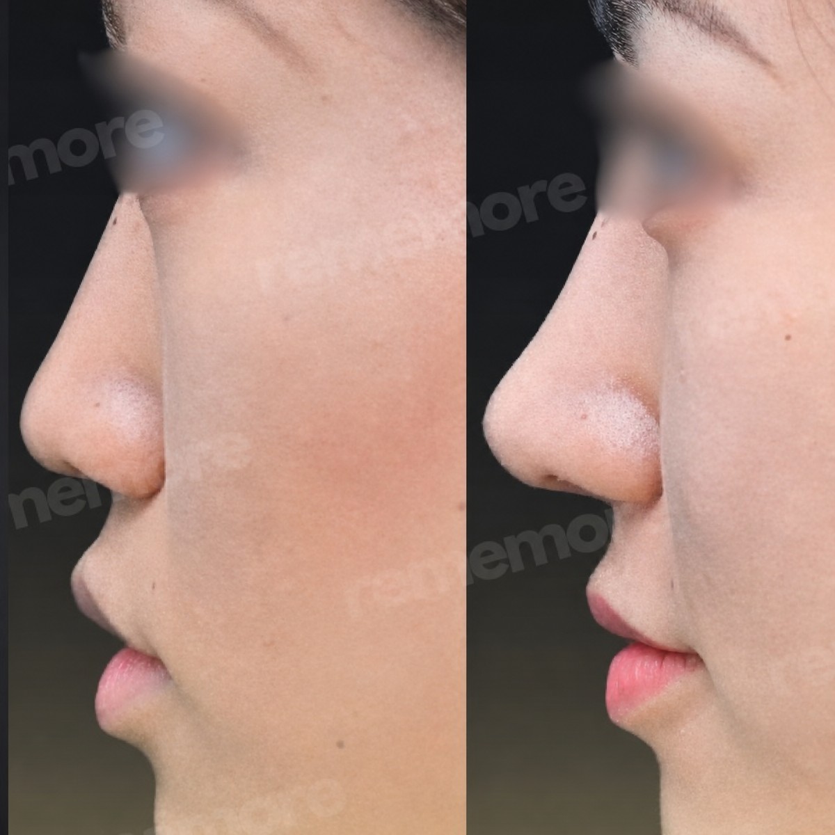Before and after rhinoplasty results at Memorial Şişli Hospital, improved nose profile