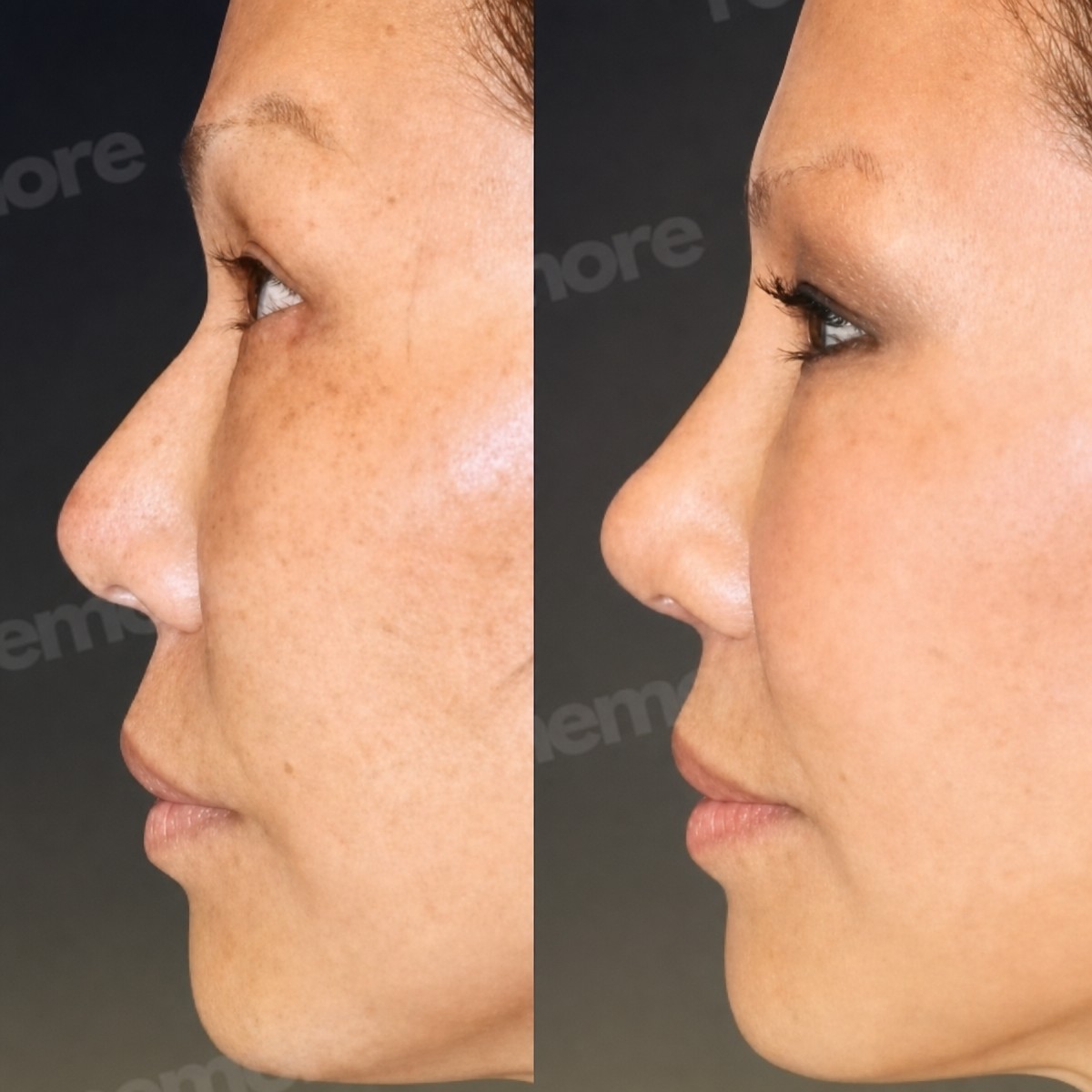 Efekty przed i po rhinoplastyce w Memorial Şişli Hospital, poprawiony profil nosa