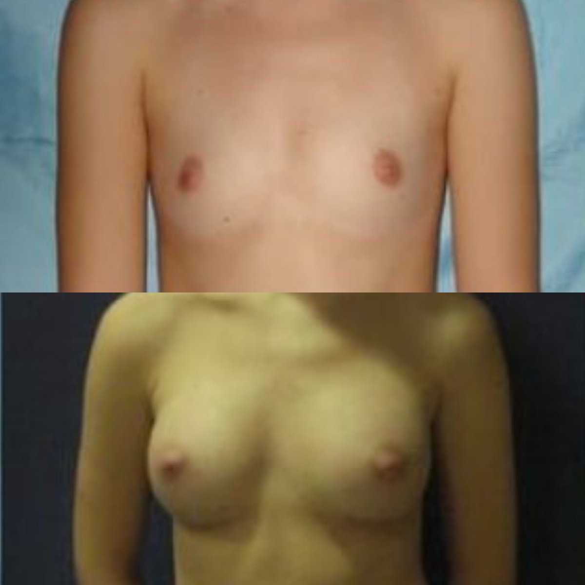 Before and after breast augmentation results at Memorial Şişli Hospital, enhanced breast shape