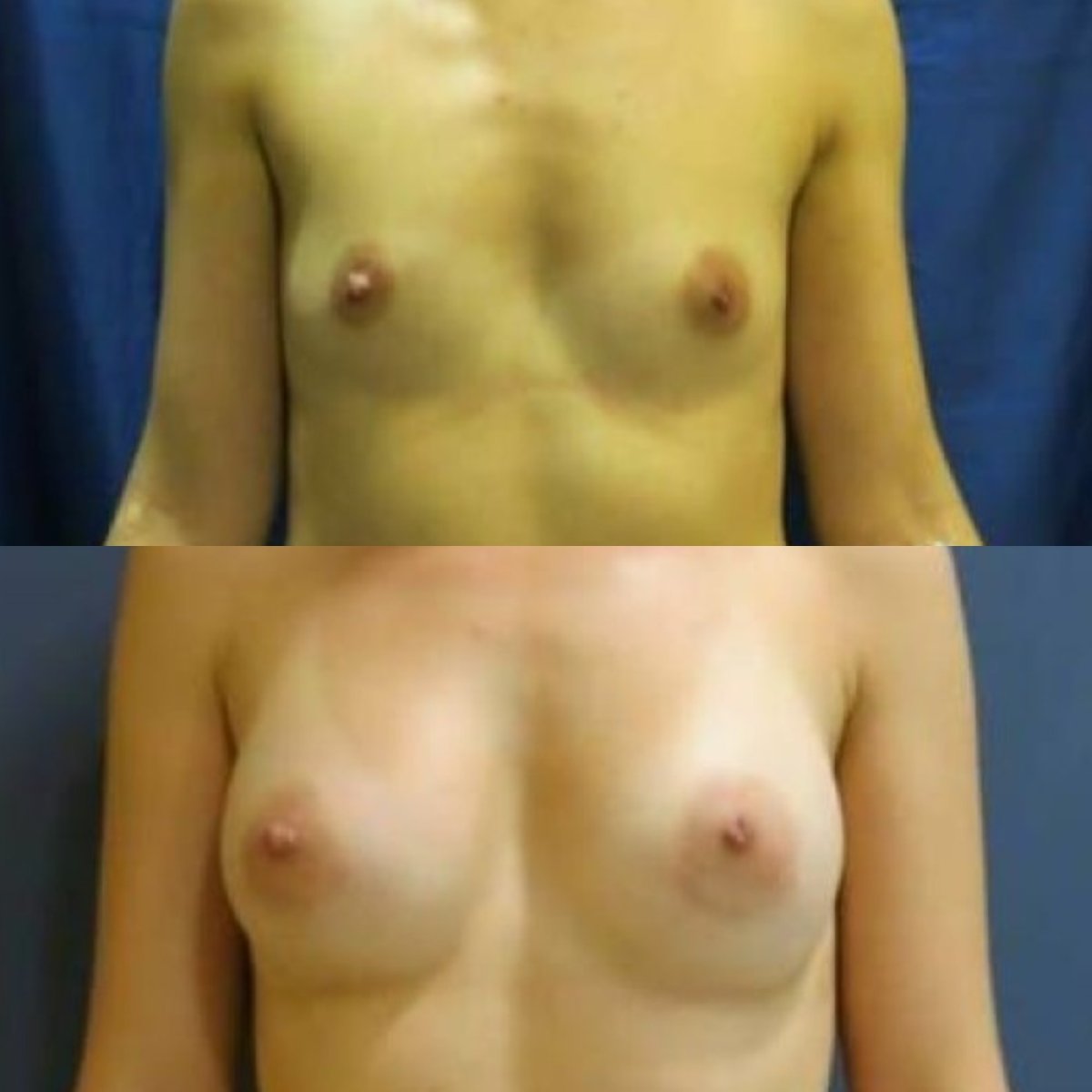 Before and after breast augmentation results at Memorial Şişli Hospital, enhanced breast shape