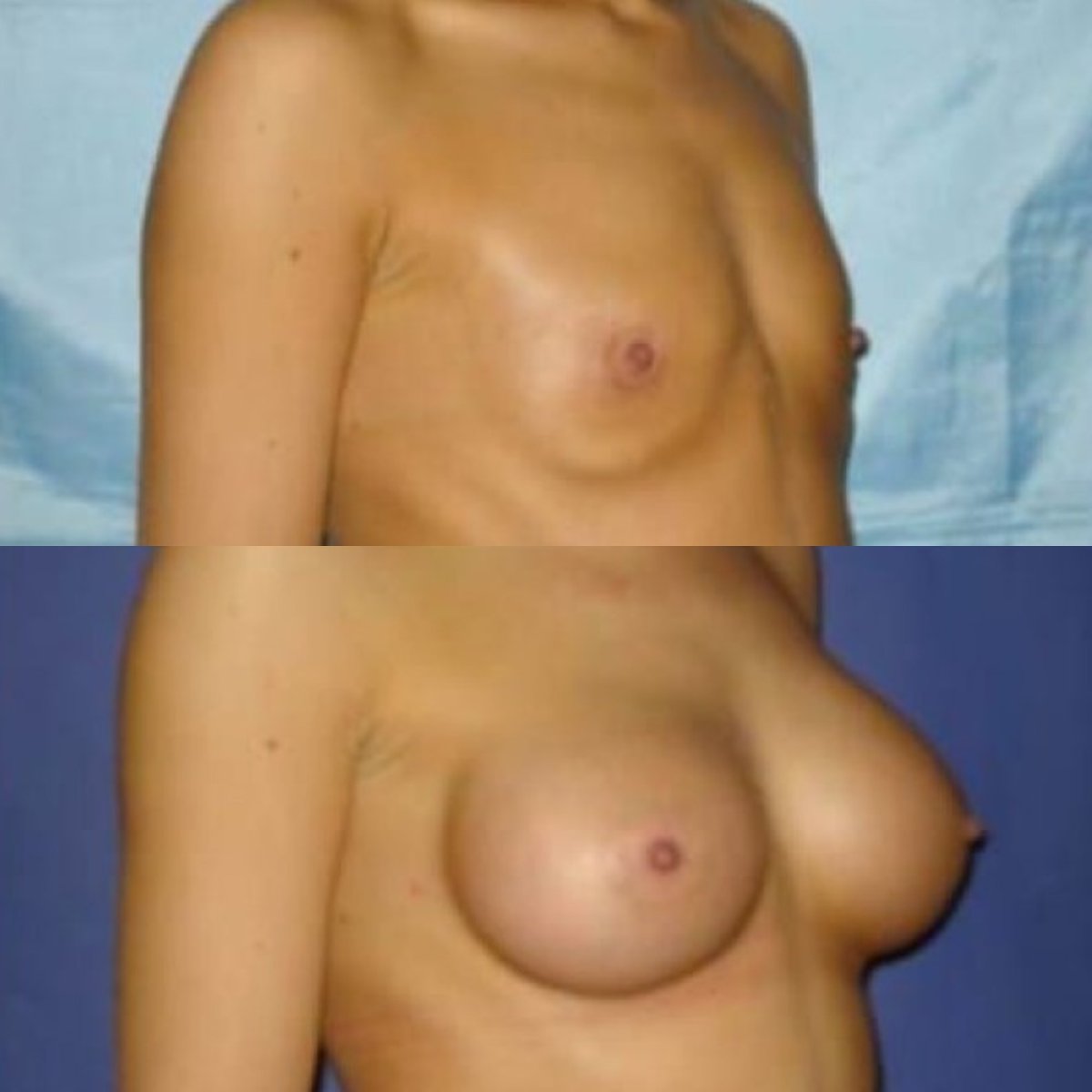 Before and after breast augmentation results at Memorial Şişli Hospital, enhanced breast shape