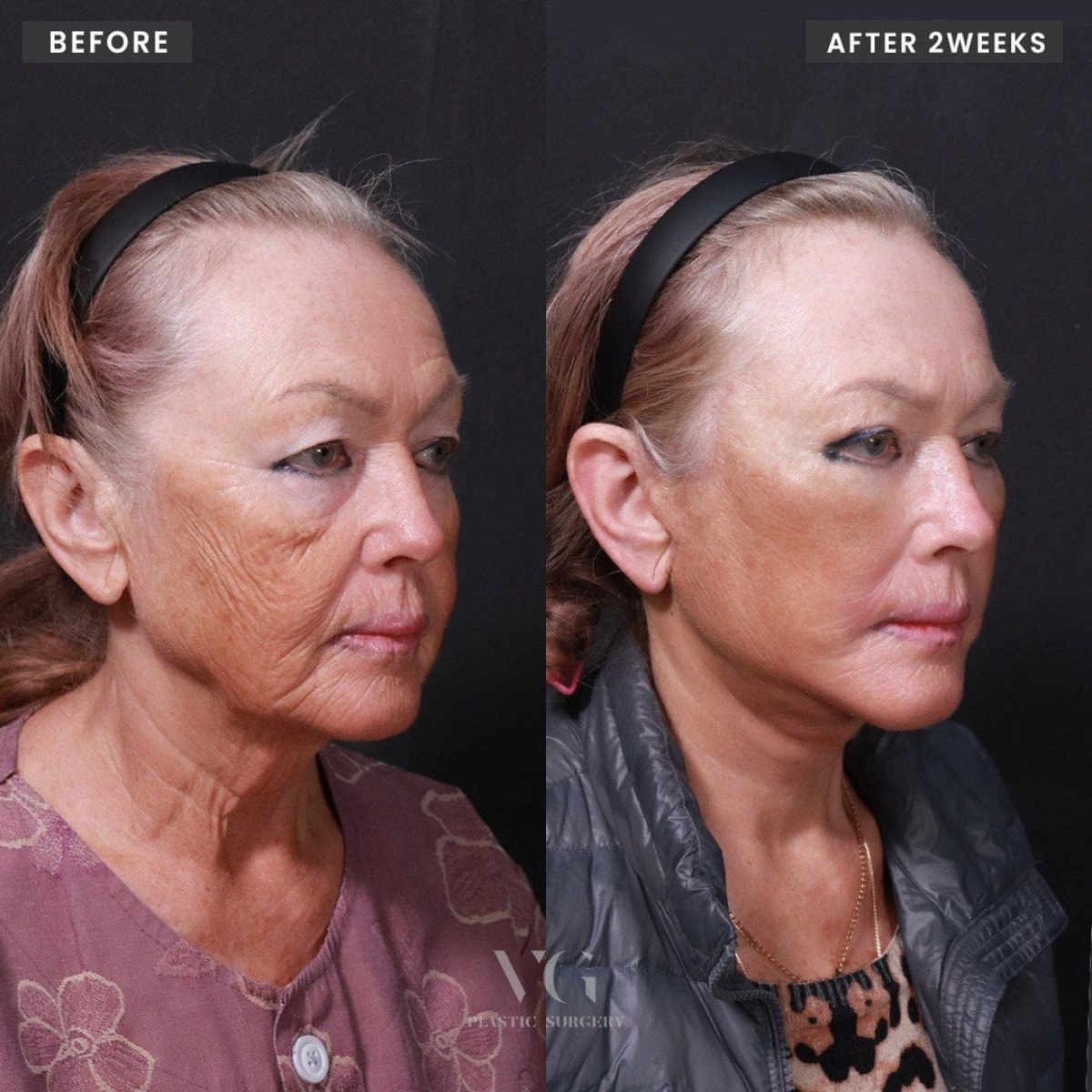 Before and after facelift results at VG Plastic Surgery, visible facial rejuvenation after 2 weeks