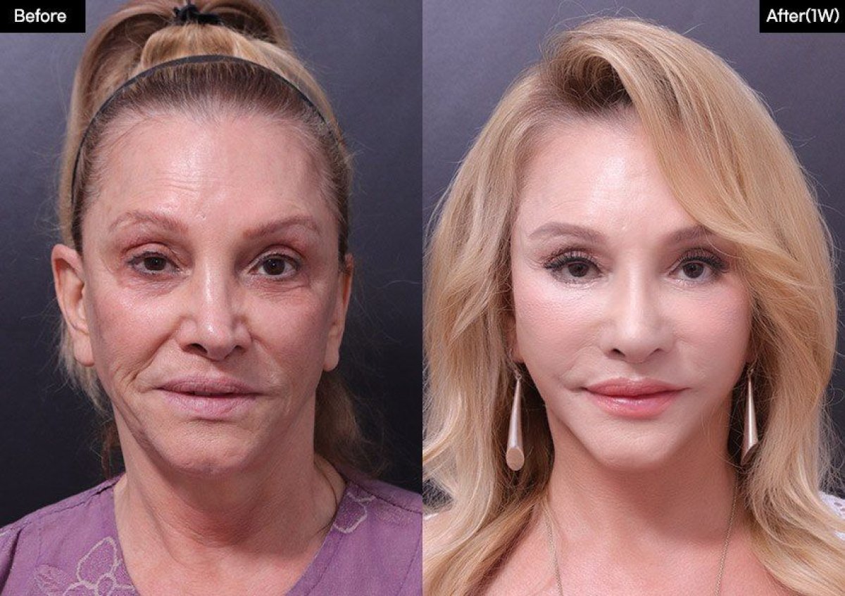 نتائج عملية شد الجفن العلوي قبل وبعد في VG Plastic Surgery، مظهر عيون متجدد