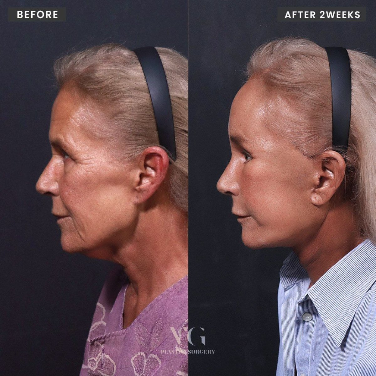 نتائج شد الوجه قبل وبعد في VG Plastic Surgery، تجديد مظهر الوجه بعد أسبوعين