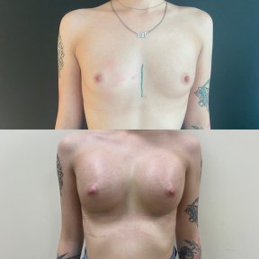 Premium Breast augmentation with Motiva® round gel breast implant All Included - photo 5