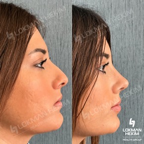 Premium Rhinoplasty (nose job) All Included - photo 5