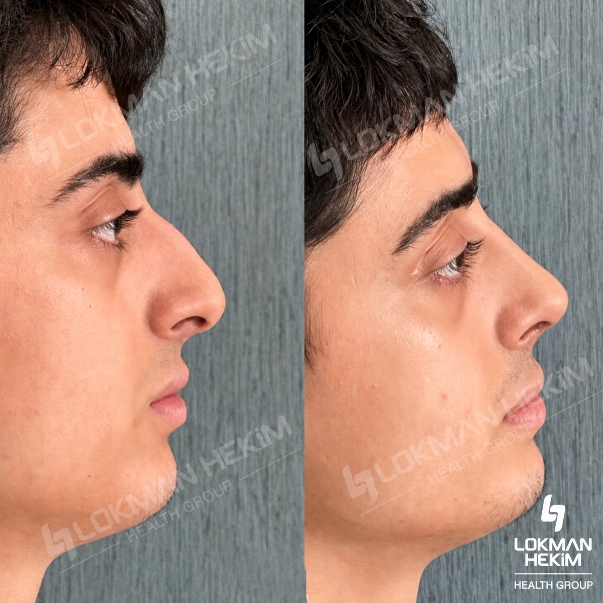نتائج عملية تجميل الأنف قبل وبعد في مستشفى لوكمان حكيم إسطنبول، تحسين شكل الأنف