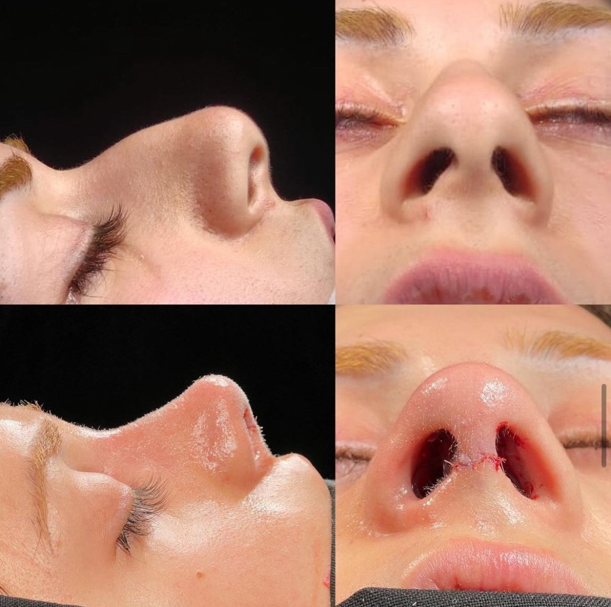 Resultados de rinoplastia antes y después en Memorial Bahçelievler Hospital, remodelación nasal