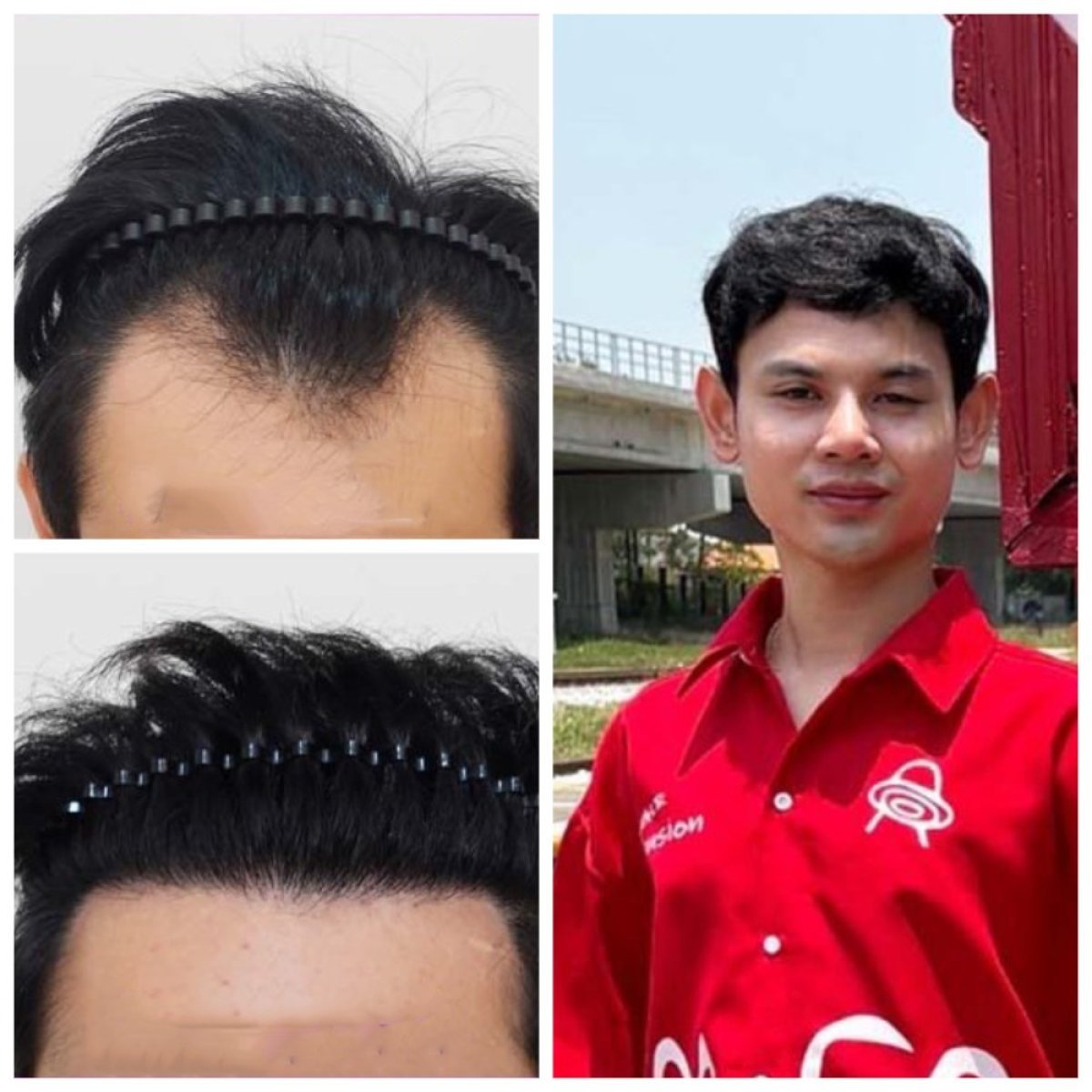نتائج زراعة الشعر قبل وبعد في قسم الجلد والجراحة - مستشفى نافامين9