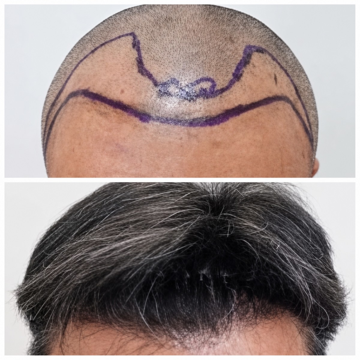 Before and after hair transplant result at Department of Skin & Surgery - NAVAMIN9 HOSPITAL