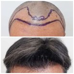 DHI hair transplantation results by Dr. Ariyapon Lortaraprasert - Patient’s before and after images Before and after DHI hair transplantation photos by Dr. Ariyapon Lortaraprasert