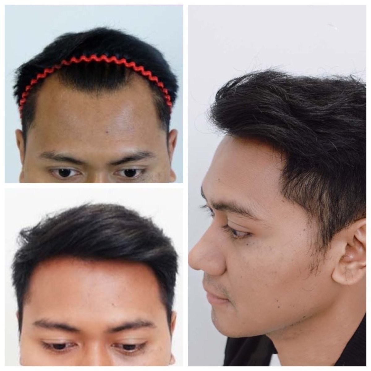 نتائج زراعة الشعر قبل وبعد في قسم الجلد والجراحة - مستشفى نافامين9