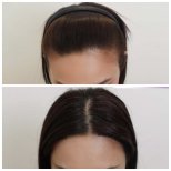 DHI hair transplantation results by Dr. Ariyapon Lortaraprasert - Patient’s before and after images Before and after DHI hair transplantation photos by Dr. Ariyapon Lortaraprasert