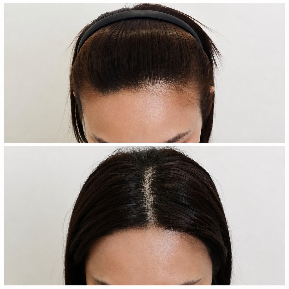 Before and after No Shave Hair Transplant result at Department of Skin & Surgery - NAVAMIN9 HOSPITAL
