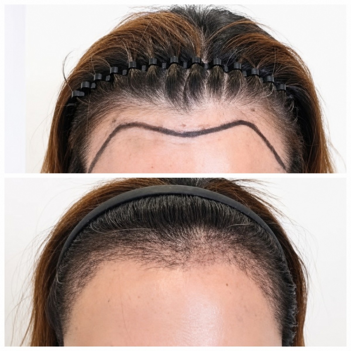 نتائج زراعة الشعر قبل وبعد في قسم الجلد والجراحة - مستشفى نافامين9