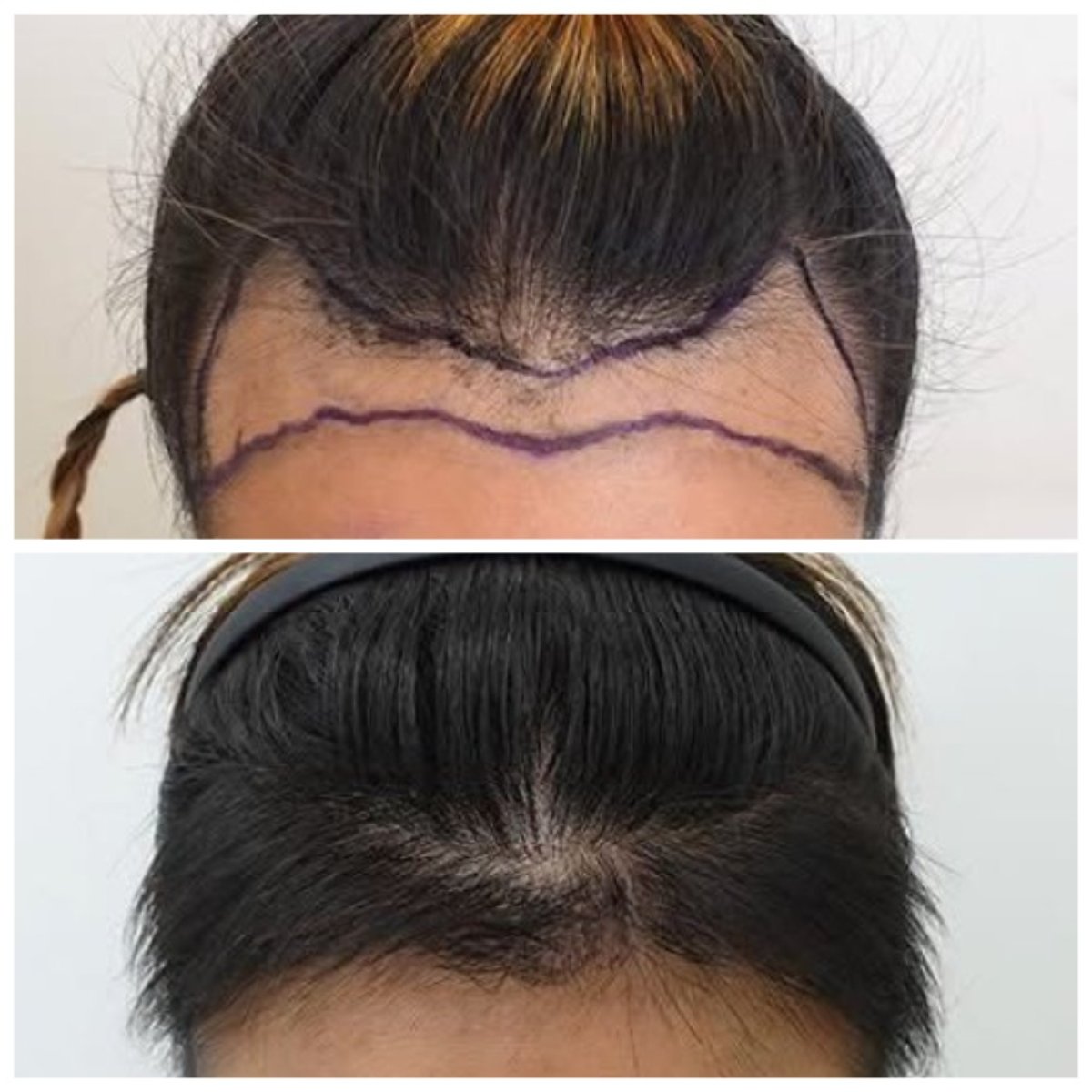 Before and after hair transplant results at Department of Skin & Surgery - NAVAMIN9 HOSPITAL
